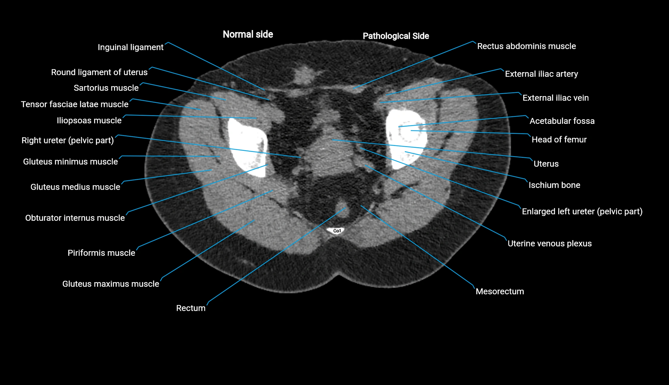 CT KUB axial cross sectional anatomy  radiology image -img-00201-00150.webp